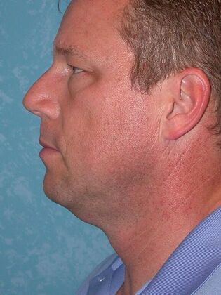 Face & Neck Lifts: Case 1333- Petersburg, OH - Before
