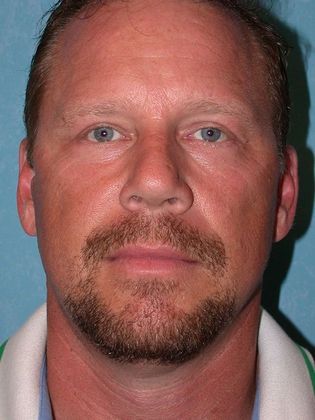 Face & Neck Lifts: Case 1333- Petersburg, OH - After