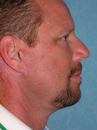 Face & Neck Lifts Case 1333- Petersburg, OH - After