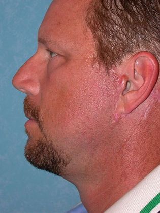 Face & Neck Lifts: Case 1333- Petersburg, OH - After