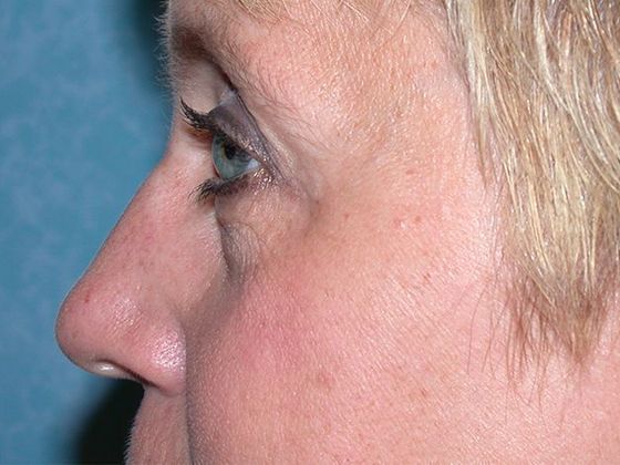 Botox® and Fillers: Case 1248- Toledo, OH - Before