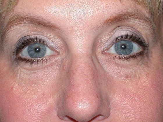 Botox® and Fillers: Case 1248- Toledo, OH - Before