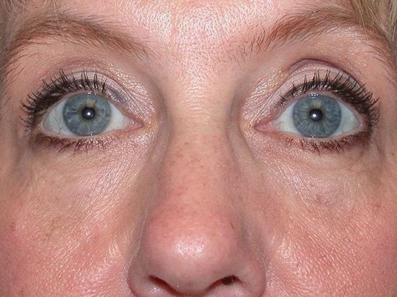 Botox® and Fillers: Case 1248- Toledo, OH - After