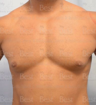 Male Breast Reduction Athletic patient with increase in mammary gland volume - Before