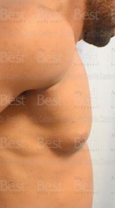 Male Breast Reduction: Athletic patient with increase in mammary gland volume - Before