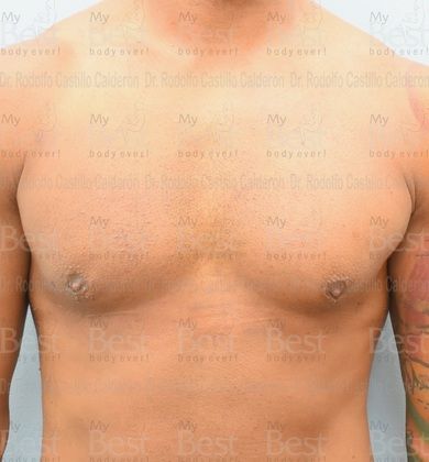 Male Breast Reduction Athletic patient with increase in mammary gland volume - After