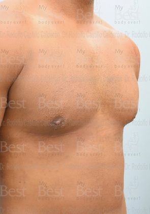 Male Breast Reduction: Athletic patient with increase in mammary gland volume - After