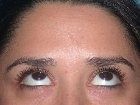 Botox® and Fillers: Case 1249- Toledo, OH - After