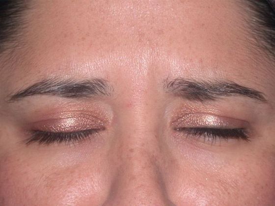 Botox® and Fillers: Case 1249- Toledo, OH - After