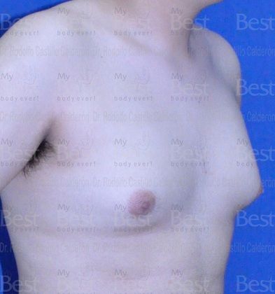 Male Breast Reduction: Breast volume increase in a teenager - Before