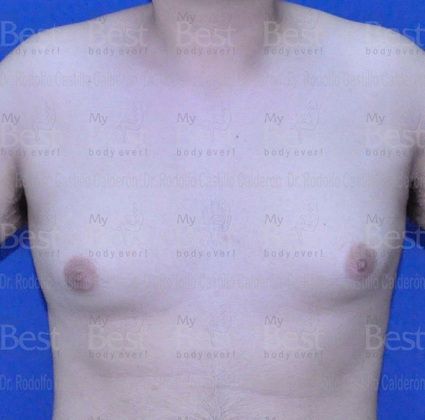 Male Breast Reduction Breast volume increase in a teenager - Before