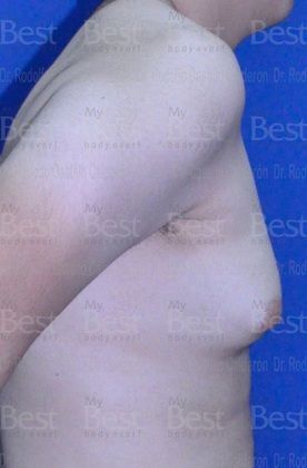 Male Breast Reduction: Breast volume increase in a teenager - Before