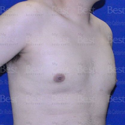 Male Breast Reduction: Breast volume increase in a teenager - After