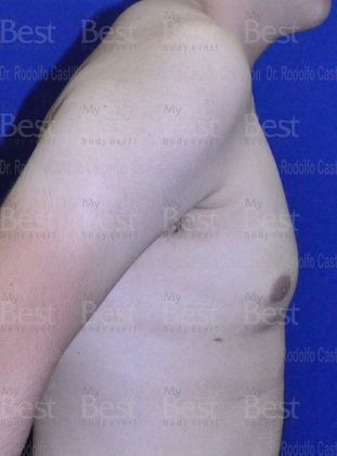 Male Breast Reduction: Breast volume increase in a teenager - After