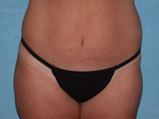 Thigh Lift Case 1406- Delta, OH - Before