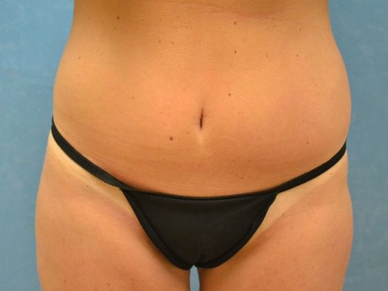 Thigh Lift Case 1406- Delta, OH - After