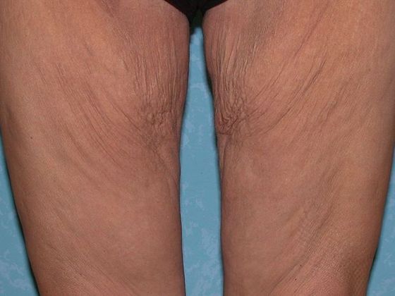 Thigh Lift Case 1407- Lyons, OH - Before