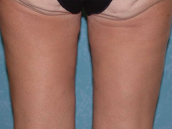 Thigh Lift: Case 1407- Lyons, OH - Before