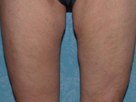 Thigh Lift Case 1407- Lyons, OH - After