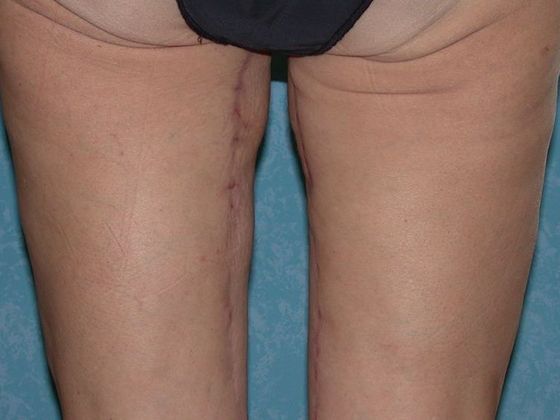 Thigh Lift: Case 1407- Lyons, OH - After
