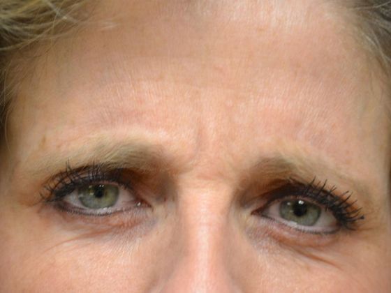Botox® and Fillers: Case 1250- Bowling Green, OH - Before