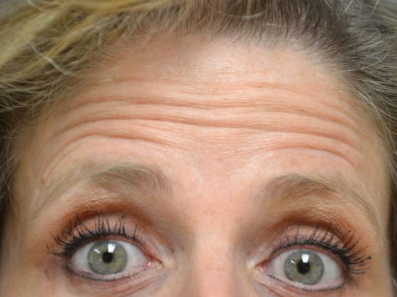 Botox® and Fillers Case 1250- Bowling Green, OH - Before