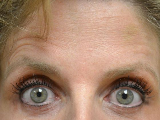 Botox® and Fillers Case 1250- Bowling Green, OH - After