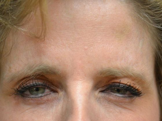 Botox® and Fillers: Case 1250- Bowling Green, OH - After
