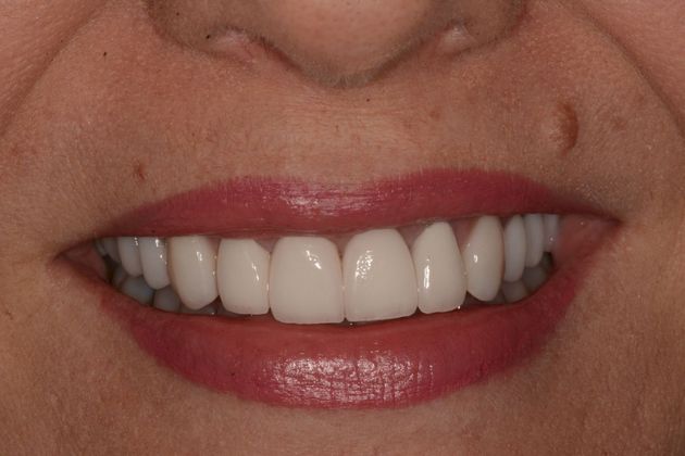 Cosmetic Dentistry Case 2 - After