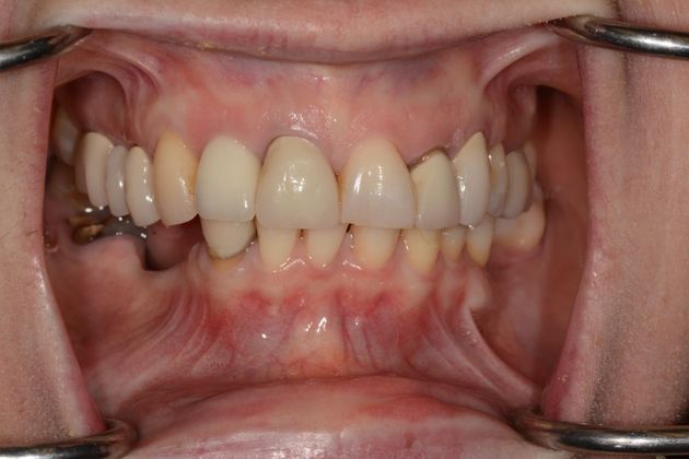 Full Mouth Rehabilitation: Case 2 - Before