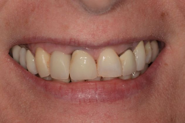 Full Mouth Rehabilitation Case 2 - Before