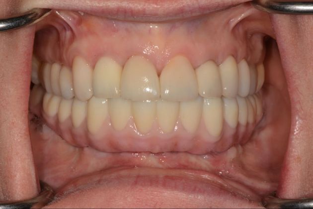 Full Mouth Rehabilitation: Case 2 - After