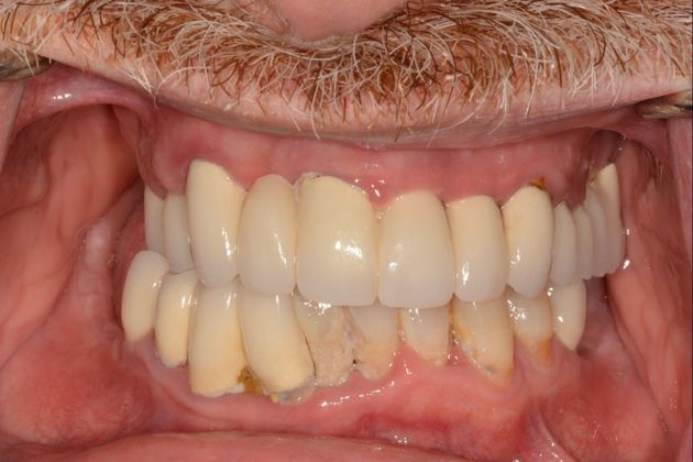 Full Mouth Rehabilitation: Case 3 - Before