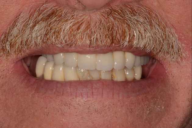 Full Mouth Rehabilitation Case 3 - Before