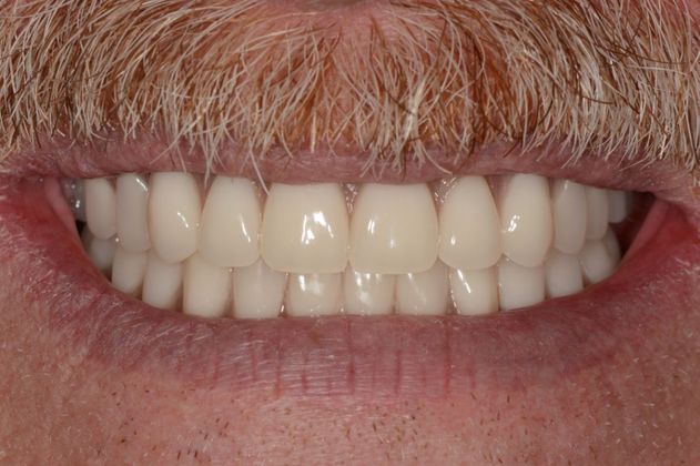 Full Mouth Rehabilitation Case 3 - After