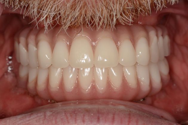 Full Mouth Rehabilitation: Case 3 - After