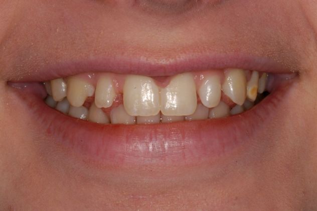 Bonding Case 2 - Before