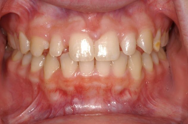 Bonding: Case 2 - Before