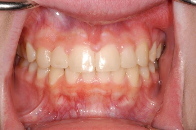 Bonding: Case 2 - After