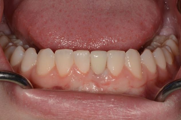 Dental Implants Case 3 - After