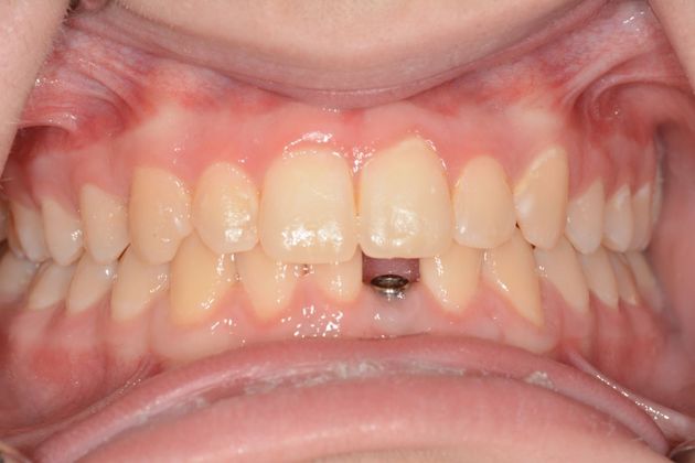 Dental Implants Case 3 - Before