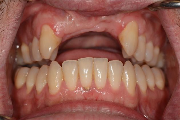 Dental Implants: Case 4 - Before