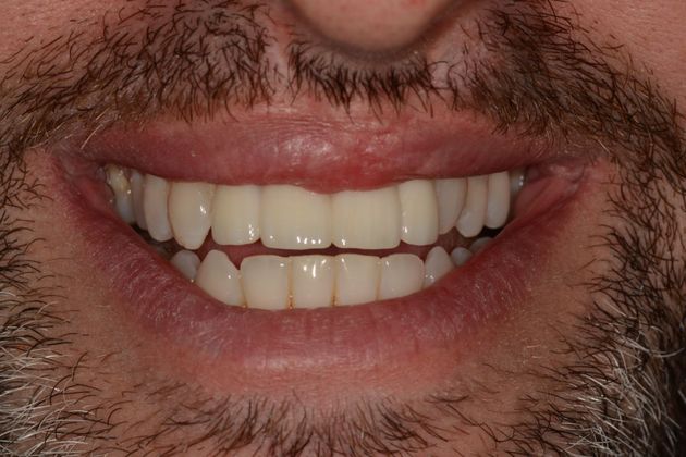 Dental Implants Case 4 - After