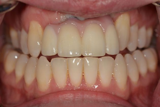 Dental Implants: Case 4 - After