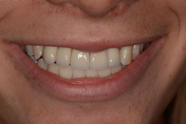 Dental Implants Case 5 - After
