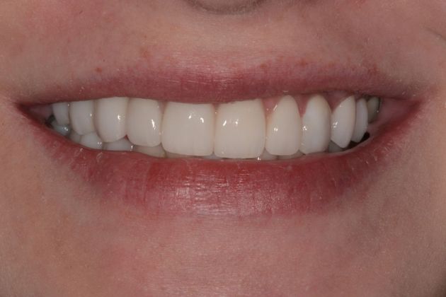 Implant/Crown/Veneer Combination Case 1 - After
