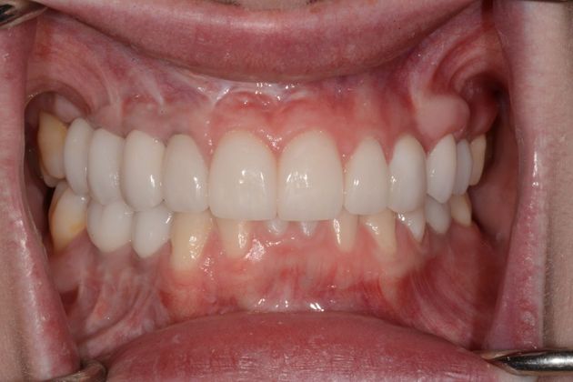 Implant/Crown/Veneer Combination: Case 1 - After