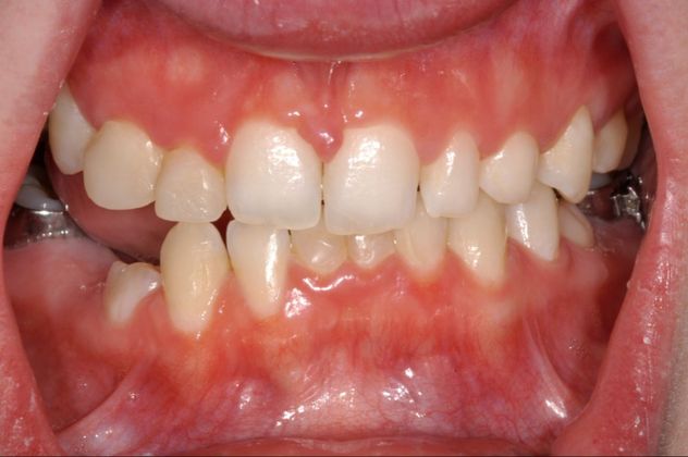 Implant/Crown/Veneer Combination: Case 1 - Before