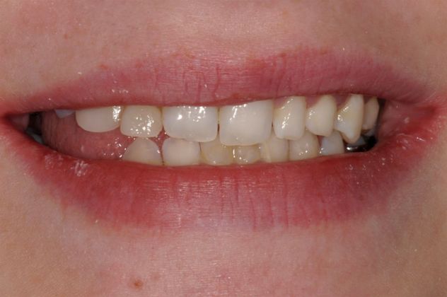 Implant/Crown/Veneer Combination Case 1 - Before