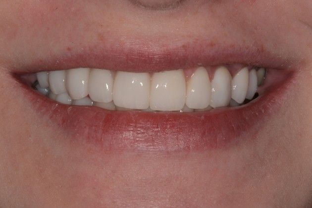 Implant/Crown/Veneer Combination Case